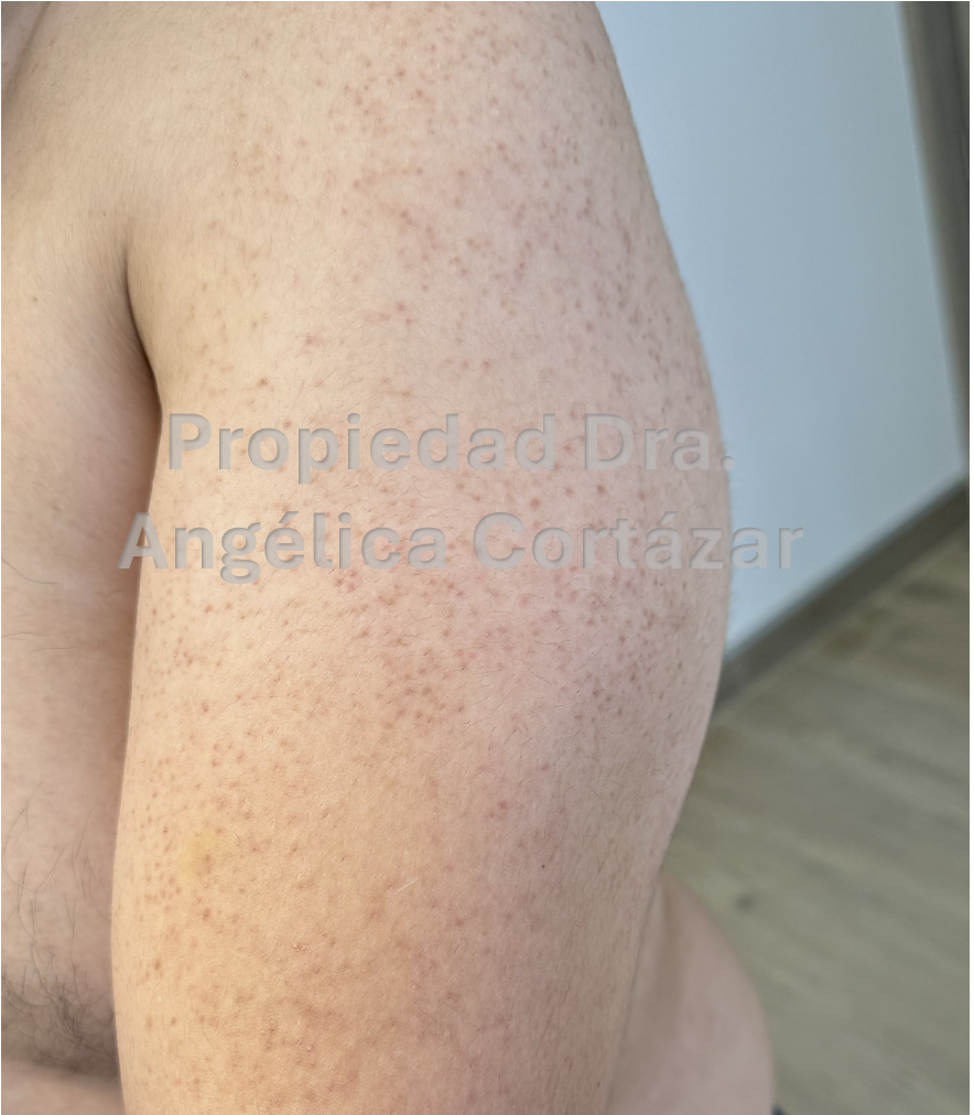 Queratosis pilaris